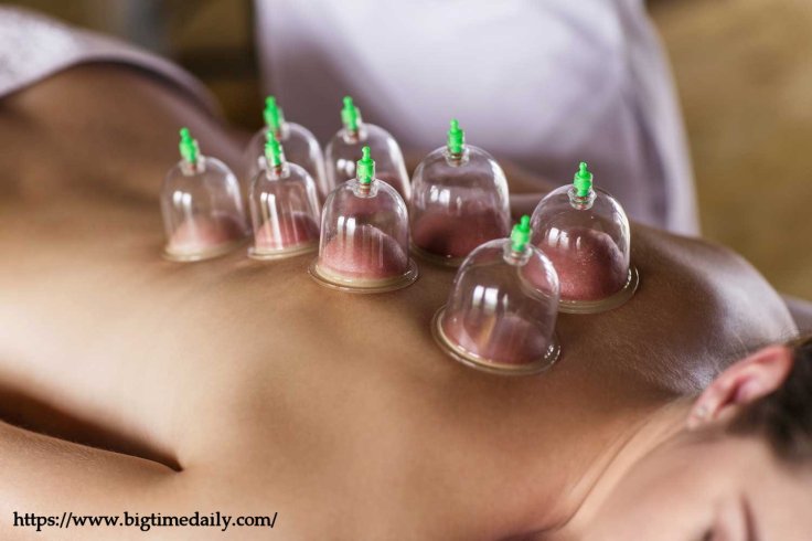 cupping-therapy
